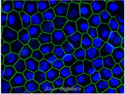 درمان یك اختلال نادر دوره كودكی با كمك سلول های برنامه ریزی شده
